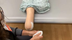 Residual Limb Management for BKA